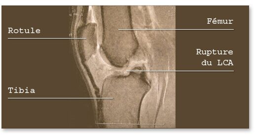 Diagnostic de la lésion à la lecture de l’IRM, ligament croisé douleur mollet