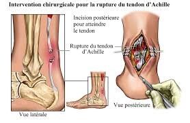 Rupture du tendon d’achille