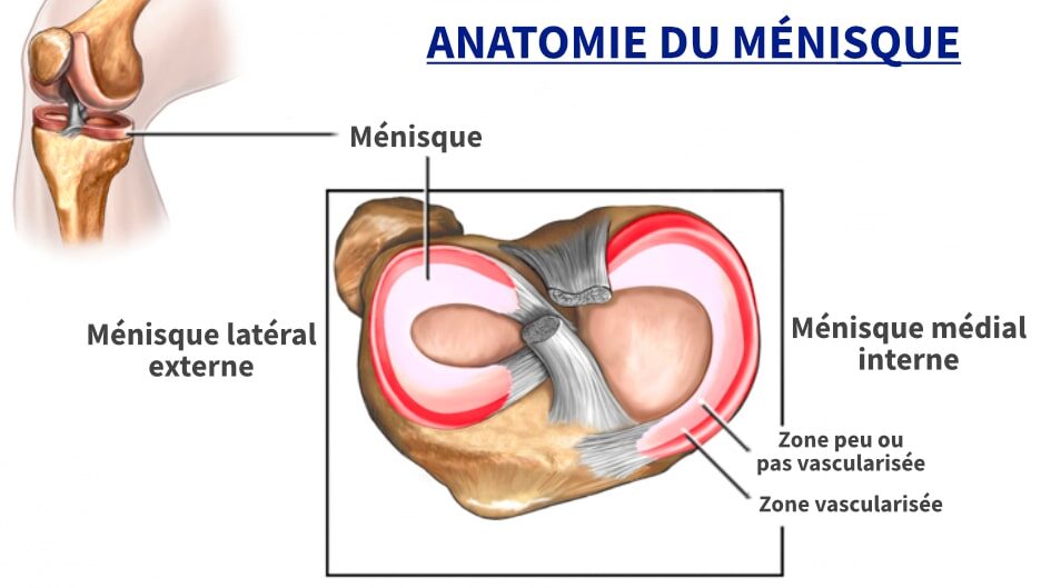 Étude Fissure méniscale, intérêt de faire une irm de la lésion méniscale, fissuration menisque grade 3, fissuration grade 3 menisque, fissuration meniscale de grade 3, fissure meniscale mediale