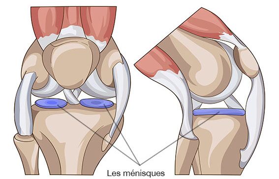 Lésions ou blocage, examen clinique pour une prise en charge dès les premières douleurs, lesions meniscales irm, menisque stade 3, atteinte meniscale irm, comment se fissurer le menisque